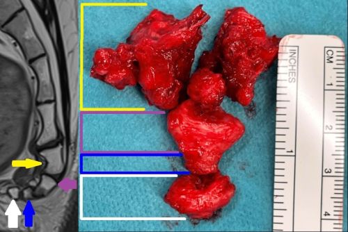 coccyx MRI and after removal